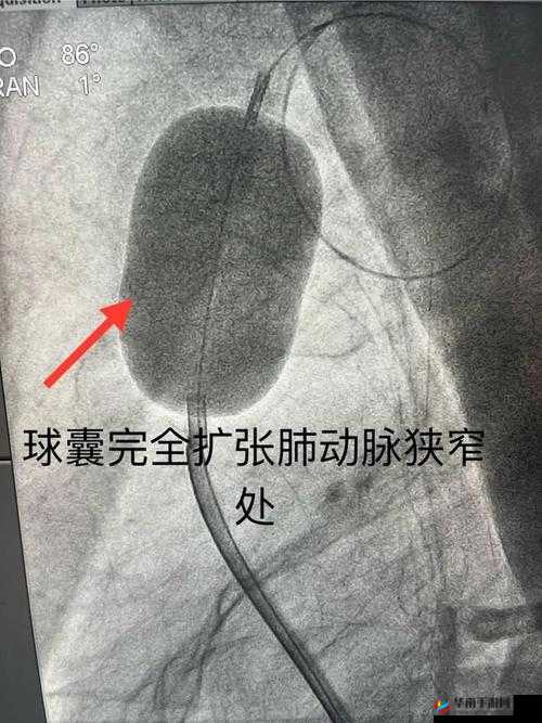 整夜堵着 3ph 系统的技术原理：用封堵球囊封堵动脉