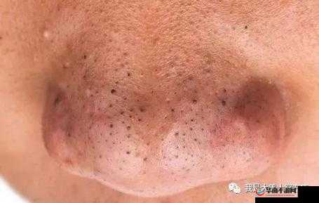 粗大黑头紫大黑头紫挤进：神奇现象