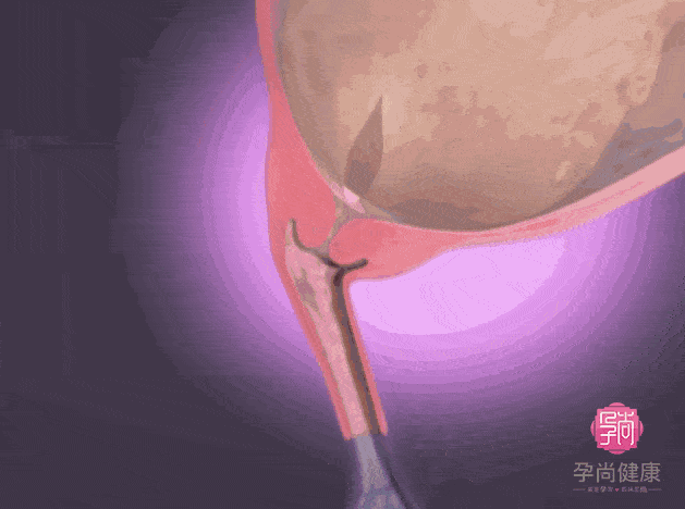 Windows Channel 孕妇生产更新动态