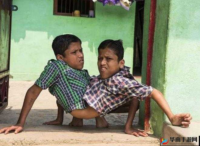 双胞胎：共享生命的奇迹