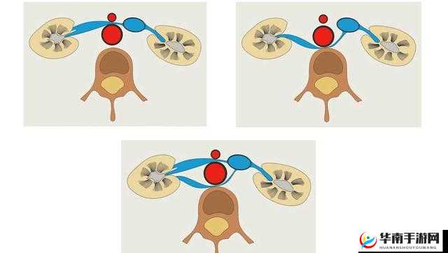 胡桃夹精索静脉曲张能治好吗：治疗方法与效果
