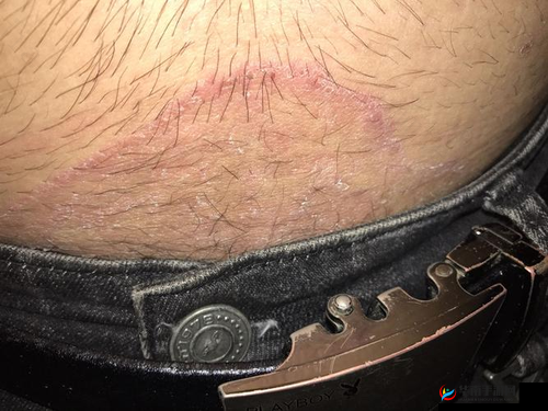 摸男生的睾丸他很痒是怎么回事：原因分析