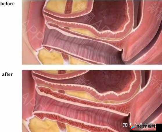 八爪鱼紧缩术：女性私密整形新选择