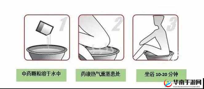 翁止熄痒最简单处理方法:盐水坐浴