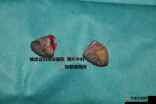 小阴天唇肥大整形有必要吗之探讨