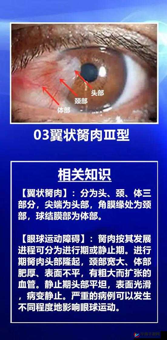 获得超级胬肉系统怎么办：如何应对获取超级胬肉系统问题