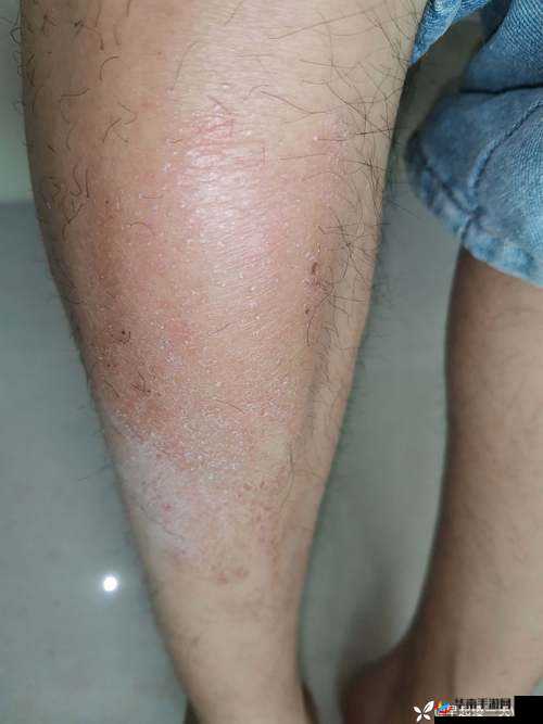 淑芬二腿间又痒了引发的困扰