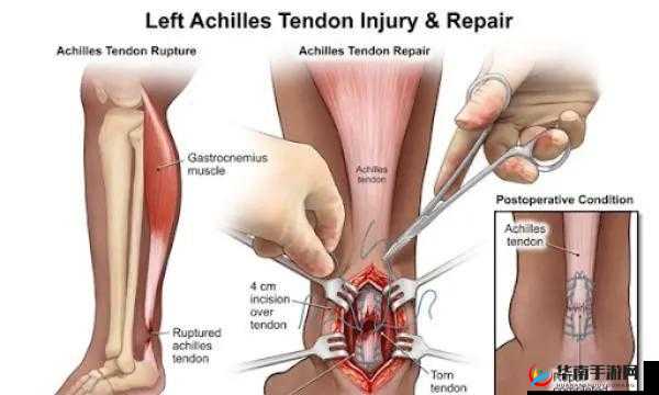 八爪鱼紧缩术：神奇的身体紧致之法