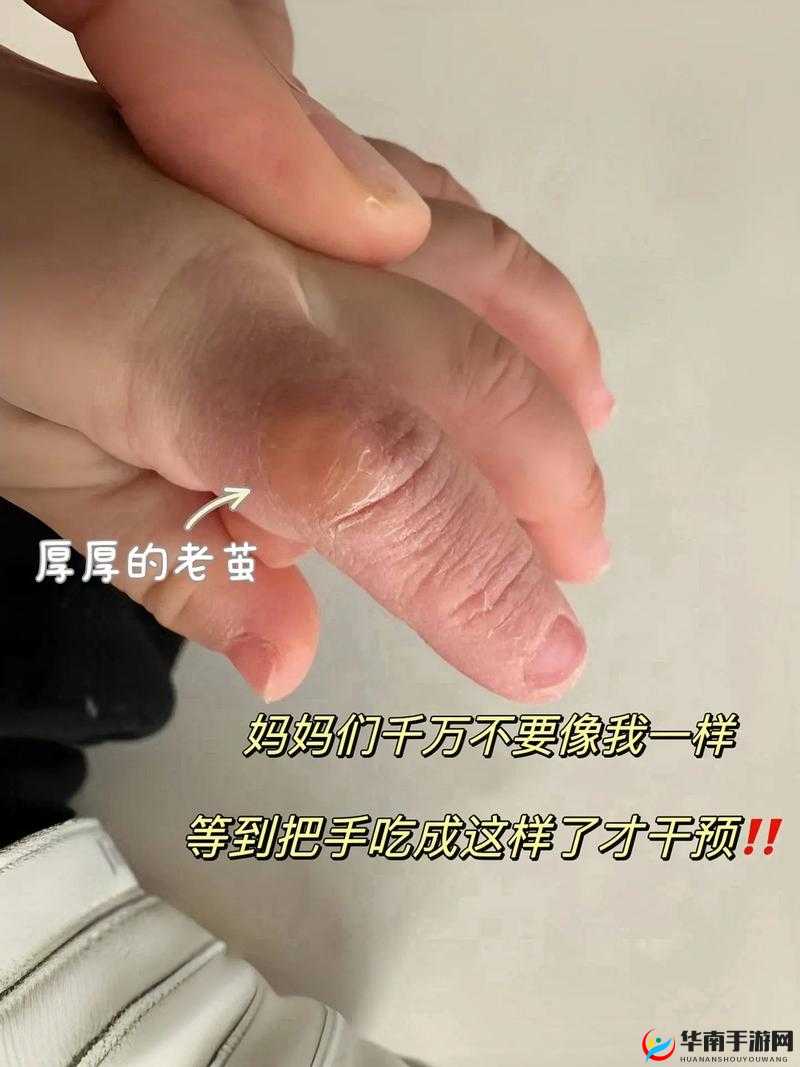 宝宝才三根手指就这么疼:背后的隐情