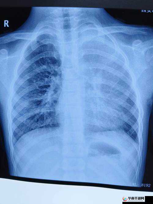 胸片全体曝光：清晰呈现胸部健康状况