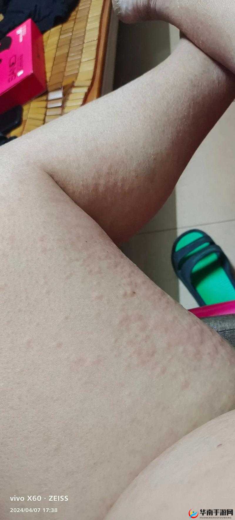 淑芬两腿中间又痒了：私密部位瘙痒的困扰