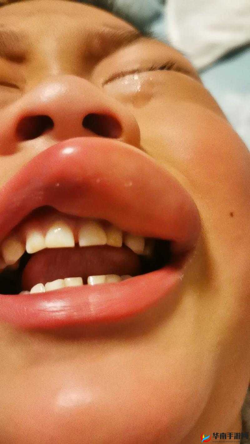 上下两张嘴都肿了：奇怪病