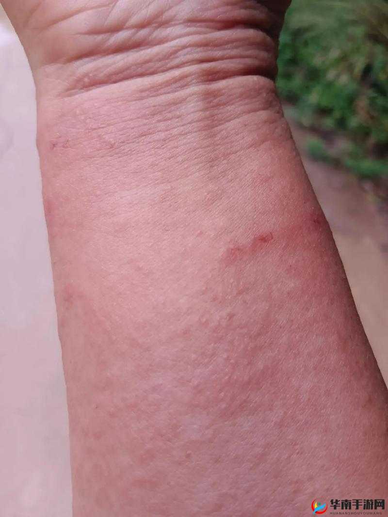 我好痒啊，那种难以言说的不适感令人困扰