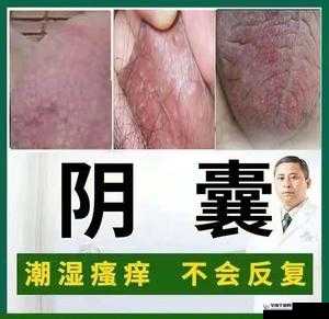 男生睾丸痒是何原因引发：摸男生睾丸他很痒是怎么回事