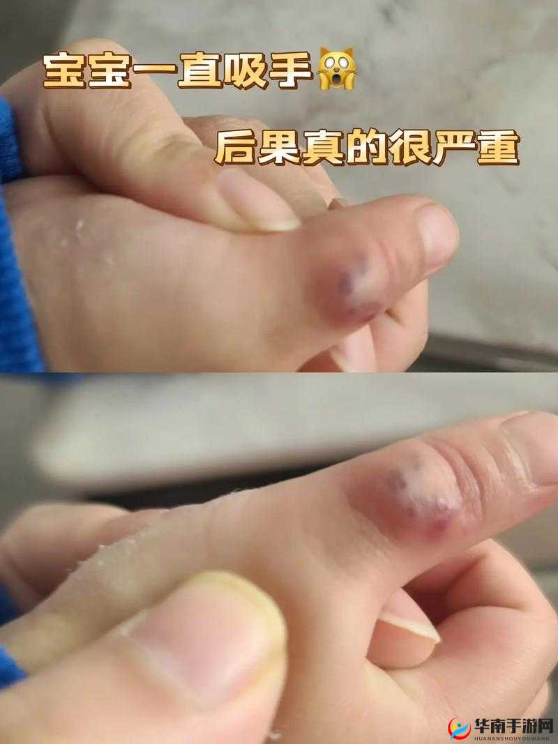 宝宝三根手指就让人疼得不行：令人担忧的现象