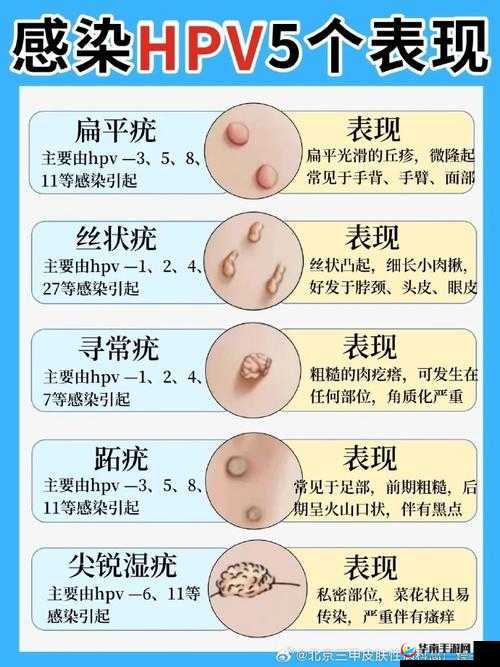 hpv 是怎么感染上的:你必须知道的事