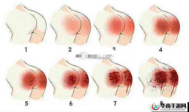 小圈 sp 红肿程度等级表：清晰图示，全面解析