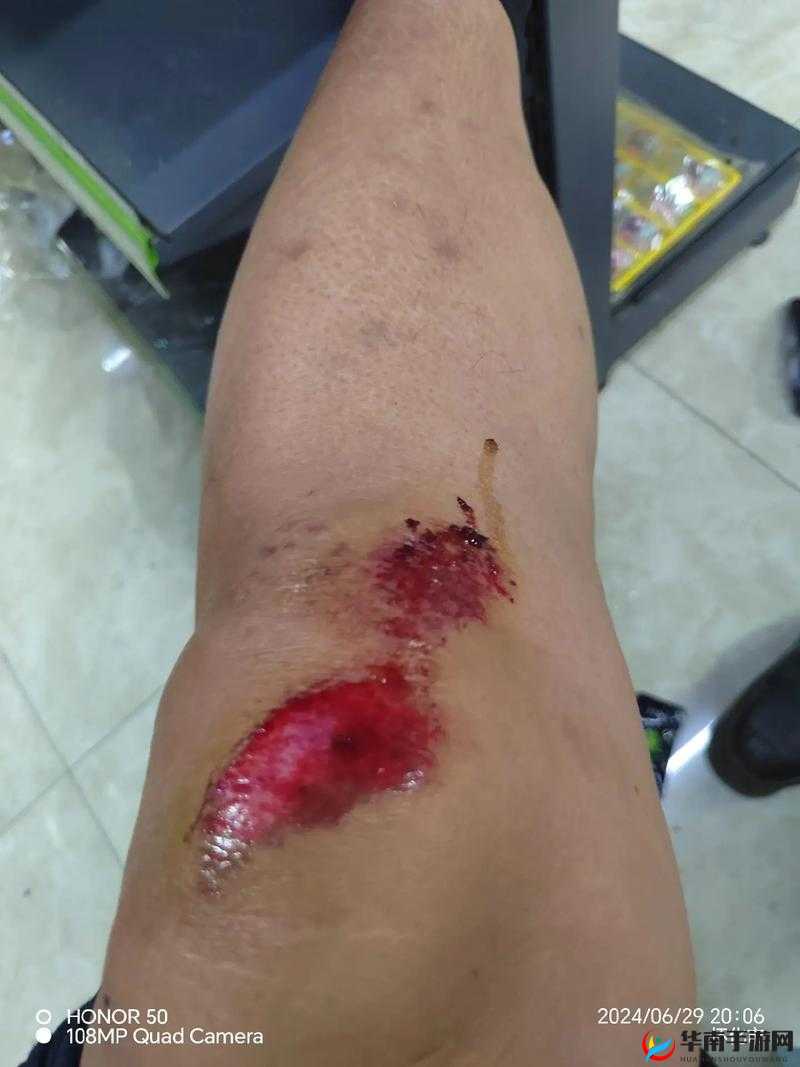 夫君摔断腿后 1V2：看我如何悉心照料陪伴康复