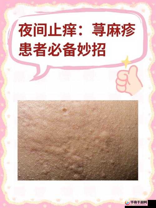 翁止熄痒最简单处理方法：快速有效止痒小妙招