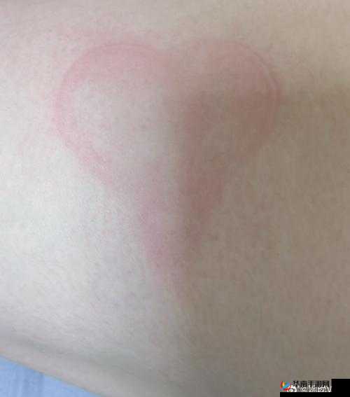 SP 发刷引发红肿双丘现象引发关注