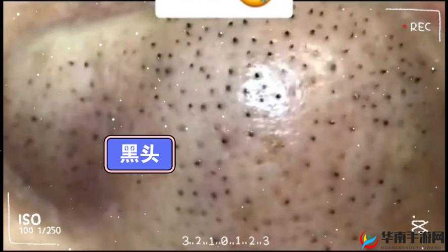 粗大黑头紫大黑头紫挤进：探秘其独特之处与背后的奥秘