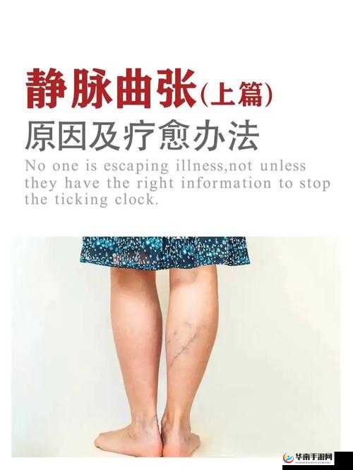 日系裸妆女士患静脉曲张的原因究竟是什么