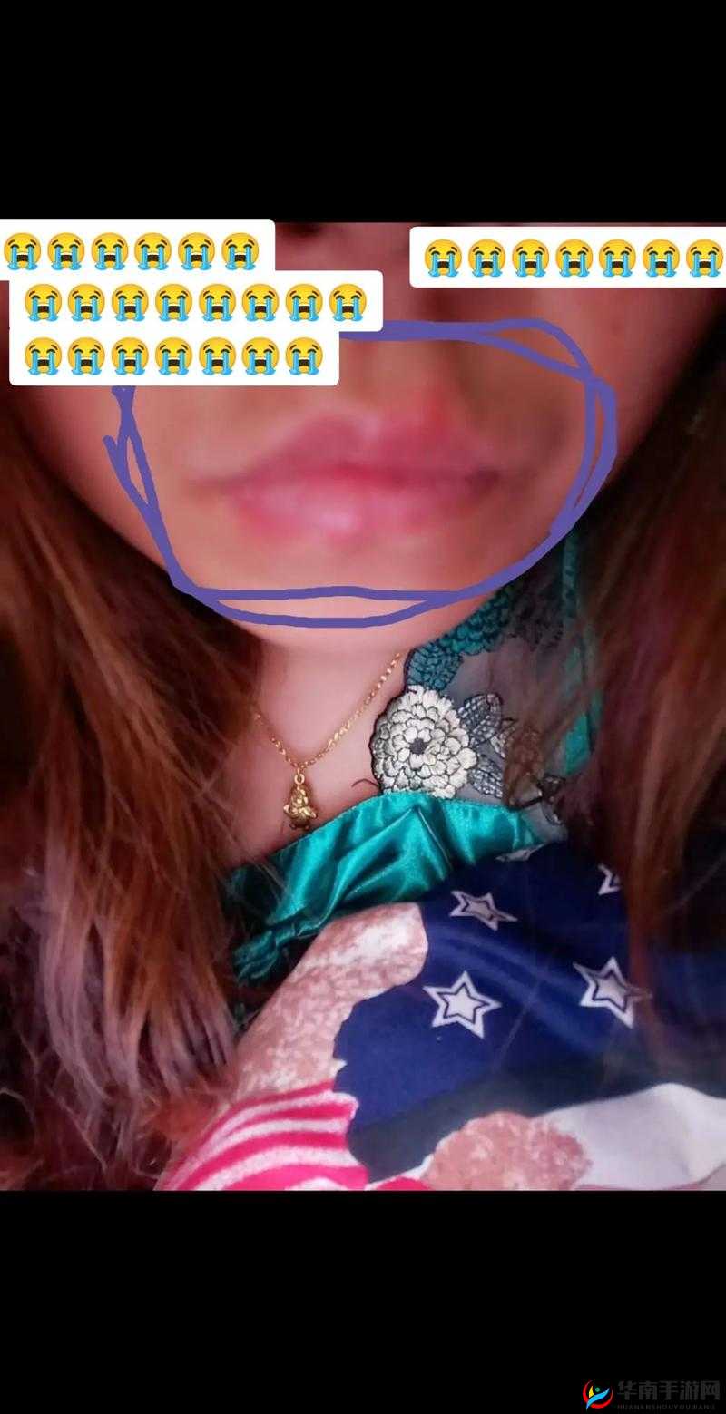 上下两张嘴都肿了：难以言说的肿胀之谜