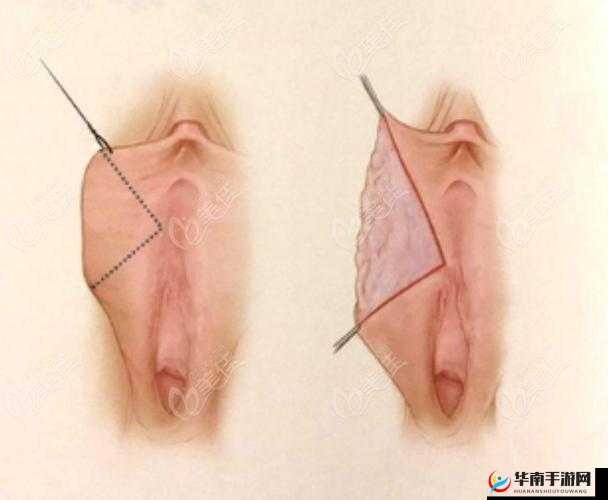 八爪鱼紧缩术：让私密部位更加紧致，提升性体验