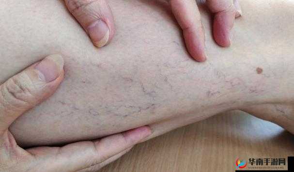 日系裸妆女士静脉曲张是什么得的：成因与预防措施全解析