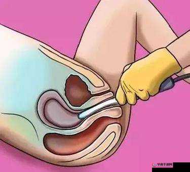 伽罗躺床流分泌物相关奇妙现象引发的思考